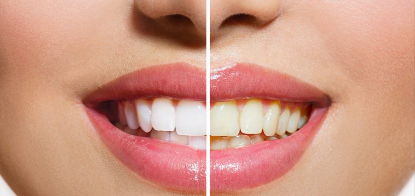 Teeth Whitening Treatment Mentone